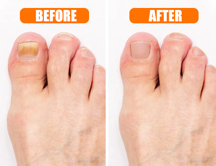 Hewelth BioClear Toenail Fungus Device before and after image